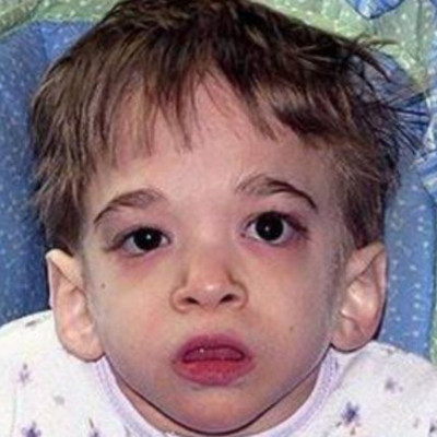 Η Ασθένεια Του Έχει Σοκάρει Τους Γιατρούς Παγκοσμίως. Μόλις Μάθετε ΠΟΣΟ Χρονών Είναι, Θα Σας Πέσει Το Σαγόνι!