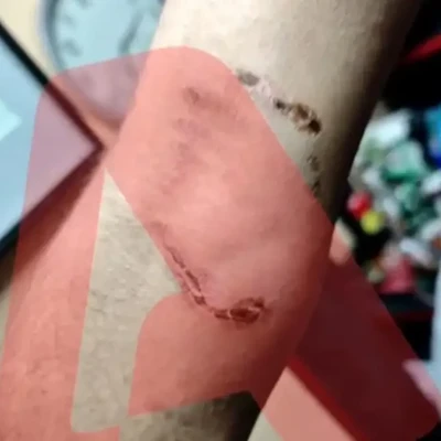 Ομόνοια: Νεαρός έβαλε το πίτμπουλ του να επιτεθεί σε 30χρονο για να τον ληστέψει – «Με έριξε κάτω και το σκυλί με δάγκωνε»