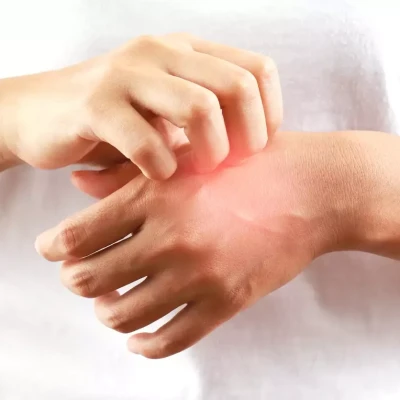 Τι είναι το αλλεργικό σοκ από το οποίο πέθανε ο 46χρονος στο Ναύπλιο: Πότε ένα τσίμπημα γίνεται απειλητικό για τη ζωή